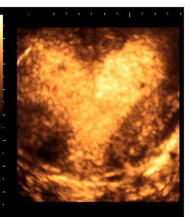 u/s scan of bicornuate uterus