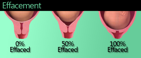 Nipple Stimulation Causes Cervix to Efface